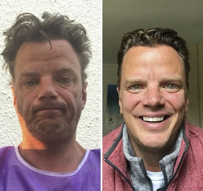 Antes e depois do tratamento Neurovix